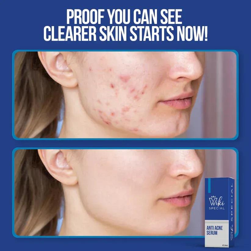 WIKI Anti-Acne & Brightening Serum 30ml